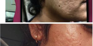 Acne Scar Treatment