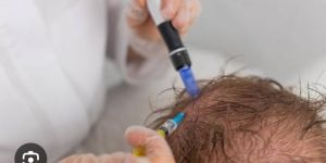 Gfc Prp Hair Procedures