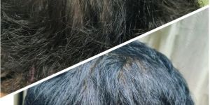 Hairfall and Hair Regrowth Treatment