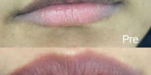 Lip Lightening Treatment