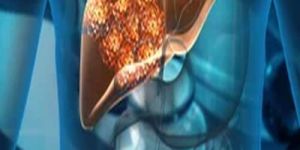 Liver Cancer Treatment Service