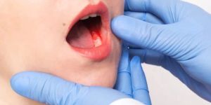 Oral Cancer Treatment Service