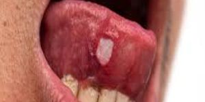 Tongue Cancer Treatment Service