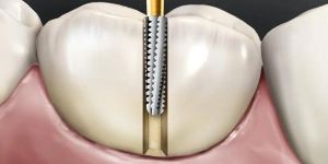 SS WHITE GREAT WHITE BUR GW-2 (PACK OF 5)