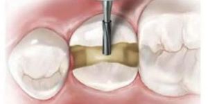 SS WHITE SURGICAL LENGTH CARBIDE FG BURS