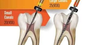 SS WHITE V-taper 2H 21MM