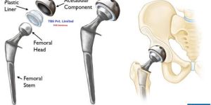 Total Hip Replacement