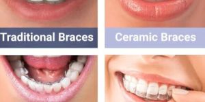 Dental Brace
