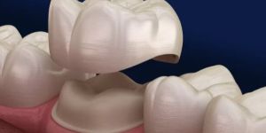 Dental Crowns