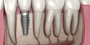 Titanium Dental Implant