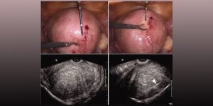 adenomyosis treatment service