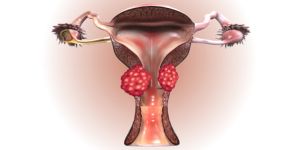 Cervical Cancer Treatment