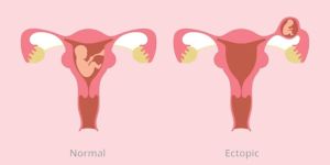 Ectopic Tubal Pregnancy Treatment