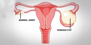 Ovarian Cancer Treatment