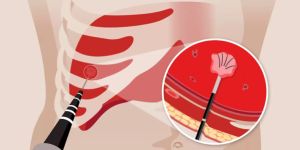 thermal ablation tumor treatment