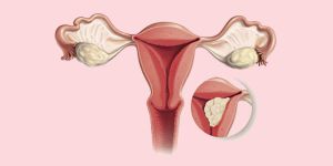 Uterine Cancer Treatment