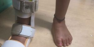 Tibia Fracture Brace