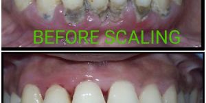 Teeth Cleaning Services