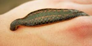 Leech Therapy