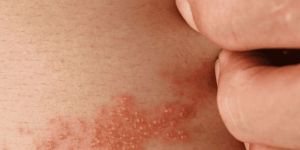 Bacterial Skin Infection Treatment