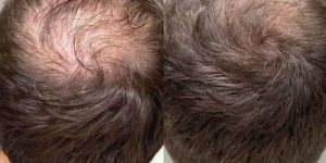 Hair Fall Treatment Service