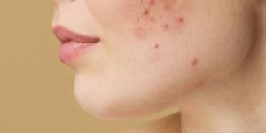 Pimple Treatment Services