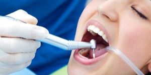 Dental Fillings