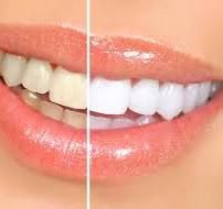 Teeth Whitening Services