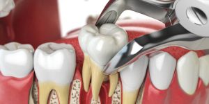 Tooth Extraction