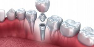 Dental Implants
