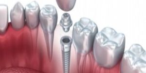 Orthodontic Implants