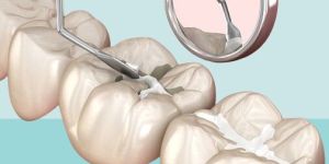 Root Canal Treatment