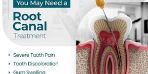 Root Canal Treatment Service