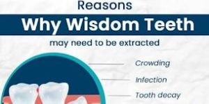 Wisdom Tooth Removal