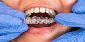 Invisalign Services
