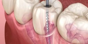 Root Canal Treatment Service