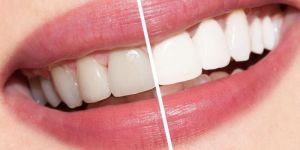 Teeth Whitening Services
