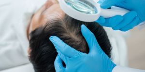 Hair Fall Treatment
