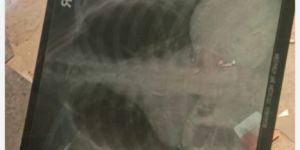 x-ray screen