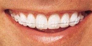 Ceramic Braces