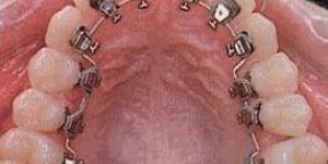 Lingual Braces