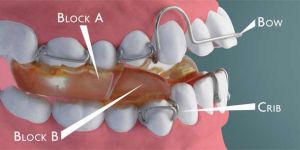 Twin Block Appliance Treatment