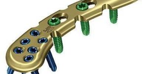 ANTERIOR CLAVICLE LOCKING PLATE