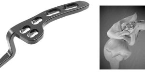 Clavicle Hook Locking Plate