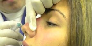 Rhinoplasty Surgery in India at ABMH