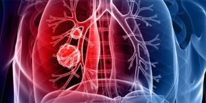 Stomach Cancer Treatment & Surgery