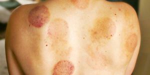 Cupping Therapy