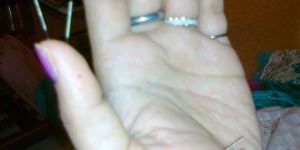 Sujok Acupuncture Therapy