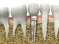 Dental Implant