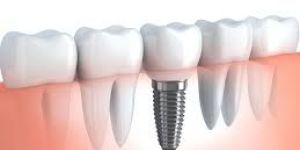 Dental Implants